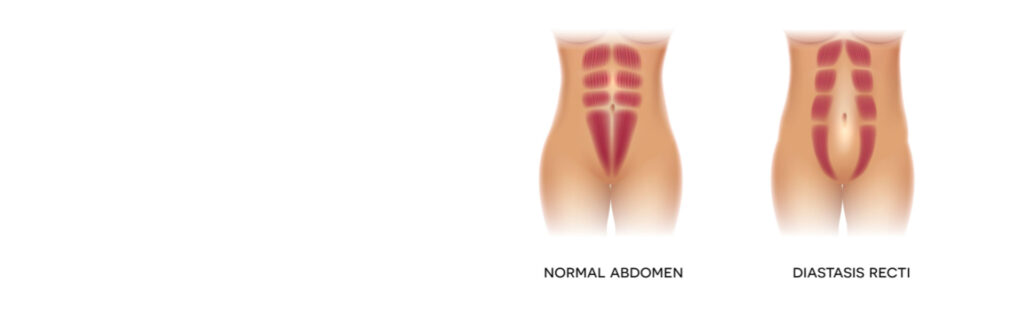 A woman's legs are shown before and after rectus diastasis surgery.