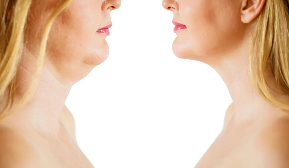 before and after image on chin lipo procedure