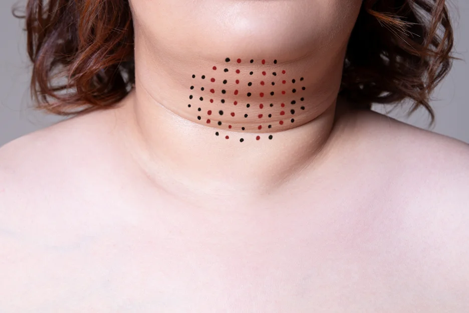 a woman had Kybella injection