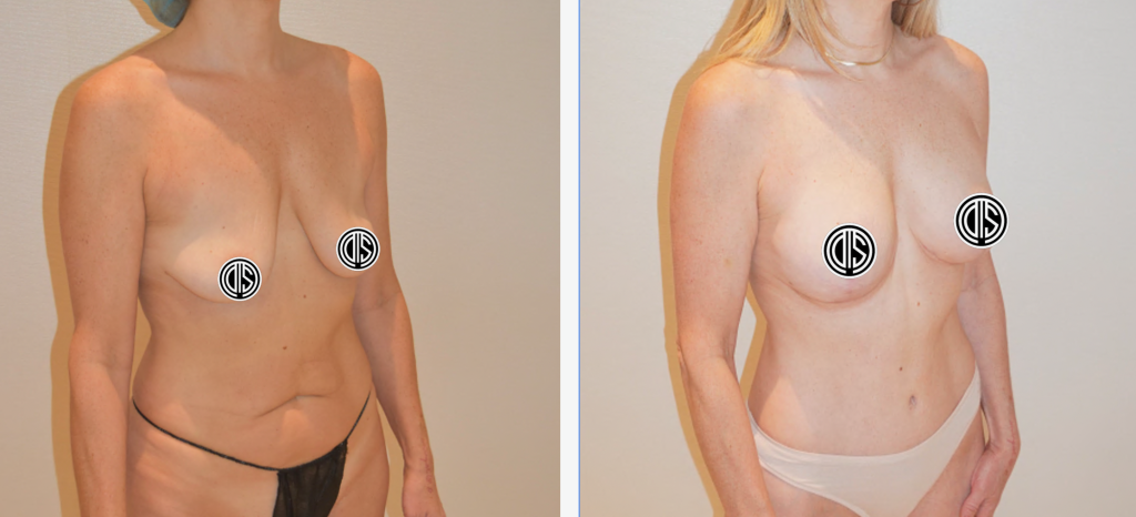 Side-by-side comparison of a woman before and after breast reconstruction surgery, both images showing her from the front at an angle—an inspiring transformation often included in a Mommy Makeover, with cost varying by procedure.