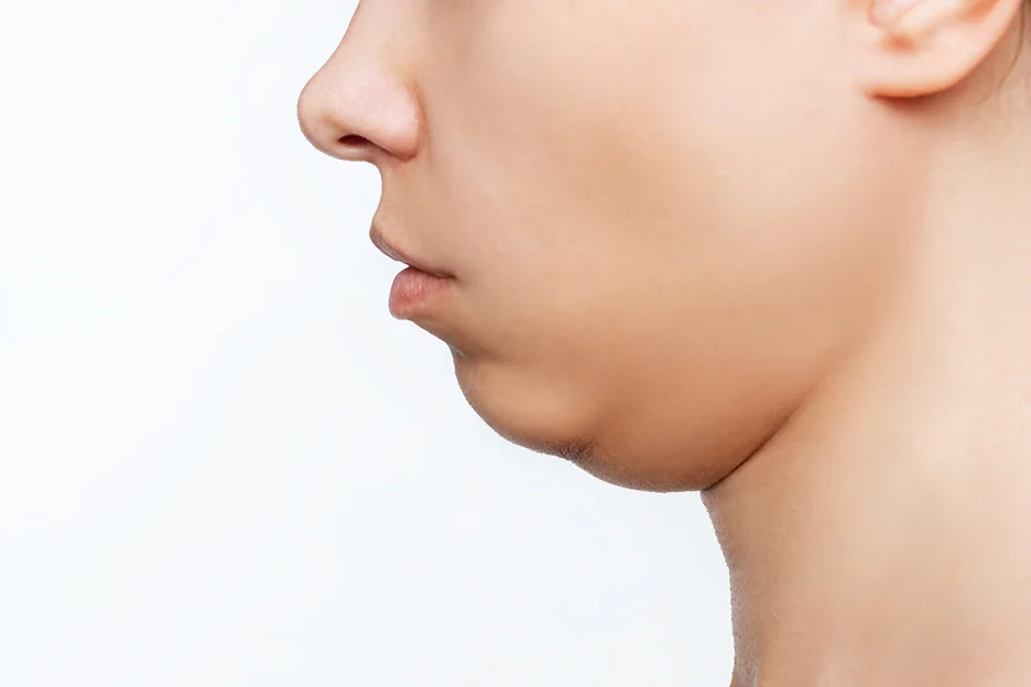 double chin