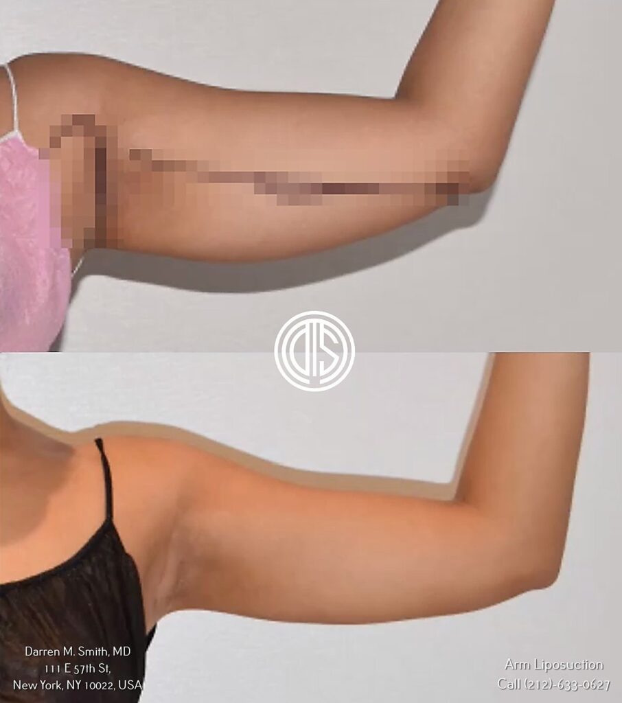 A woman's arm before and after an arm liposuction.