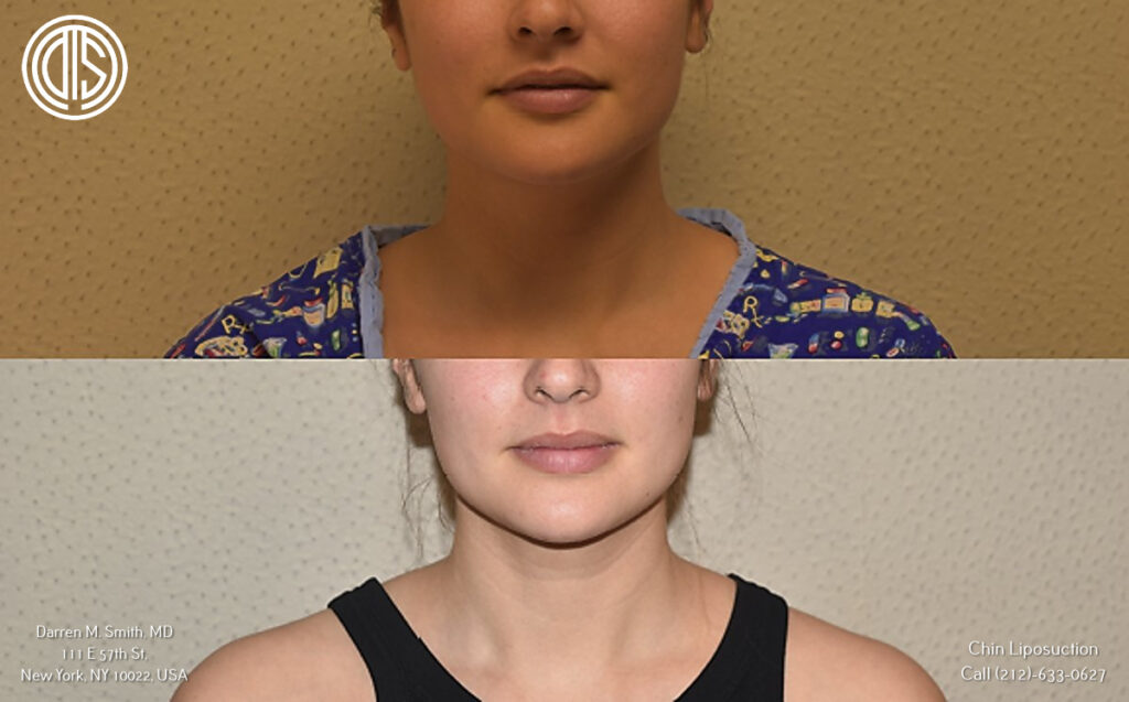 before and after portrait of a woman who had chin liposuction procedure