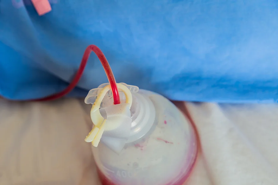 A plastic bag with blood and fluid drain, post-brachioplasty.