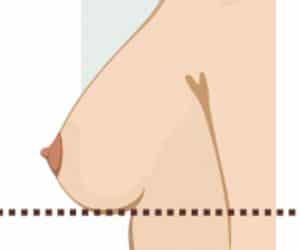 A woman's breast is shown in a diagram.