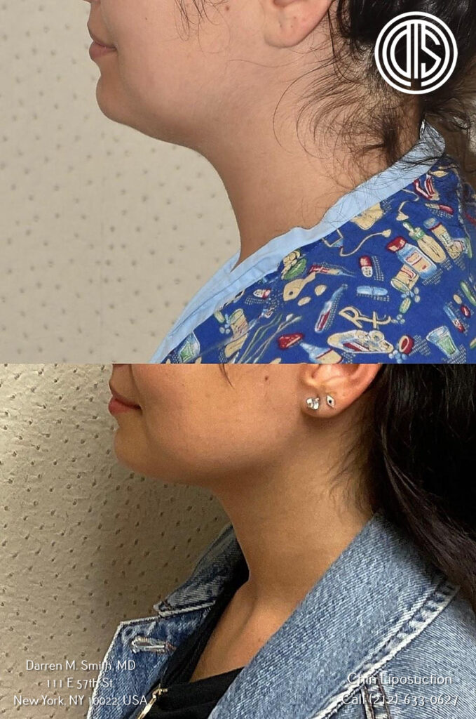 before and after portrait of a woman who went chin liposuction procedure