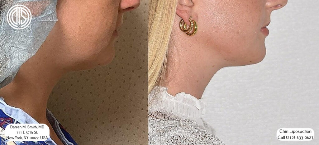 before and after portrait of a woman ho received chin liposuction