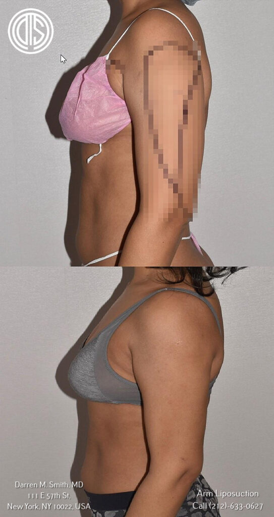 Discover the transformative results of arm lipo with stunning before and after photos.