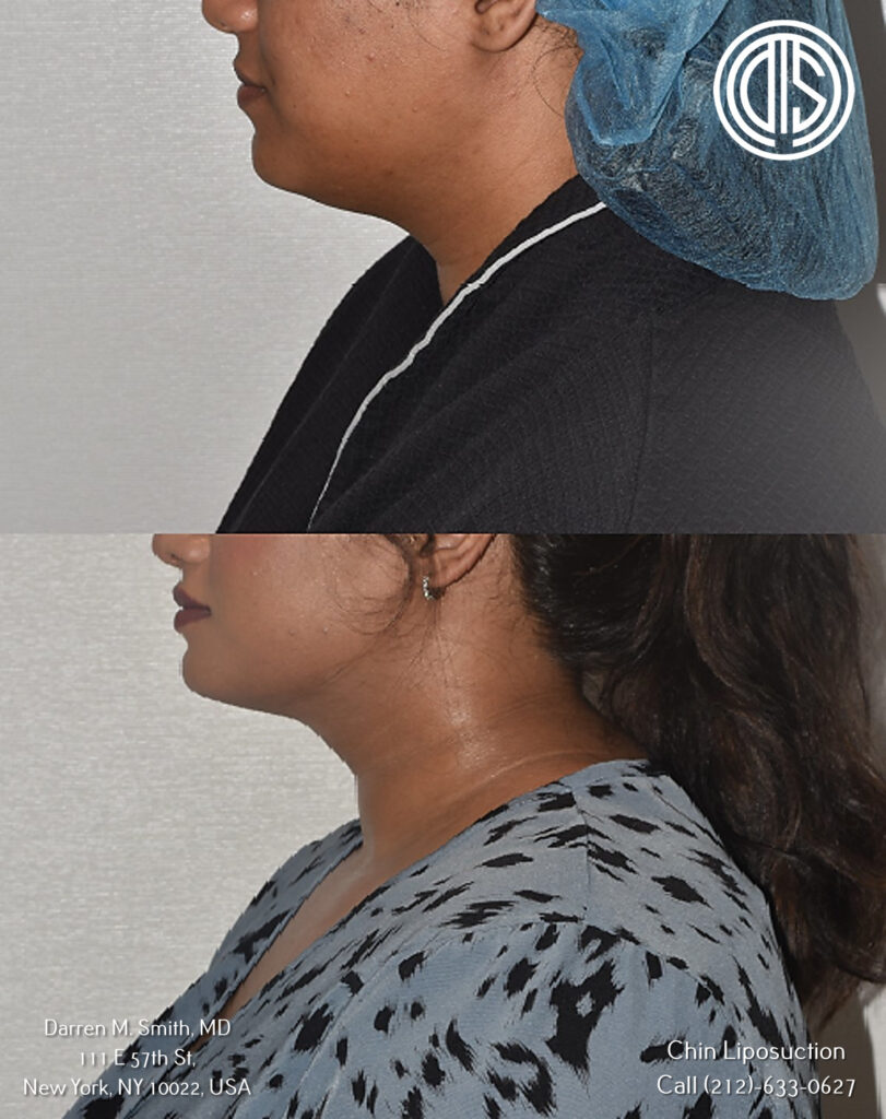 before and after portrait of a woman who had chin liposuction procedure