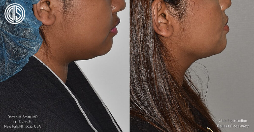 before and after portrait of a woman who underwent chin liposuction procedure
