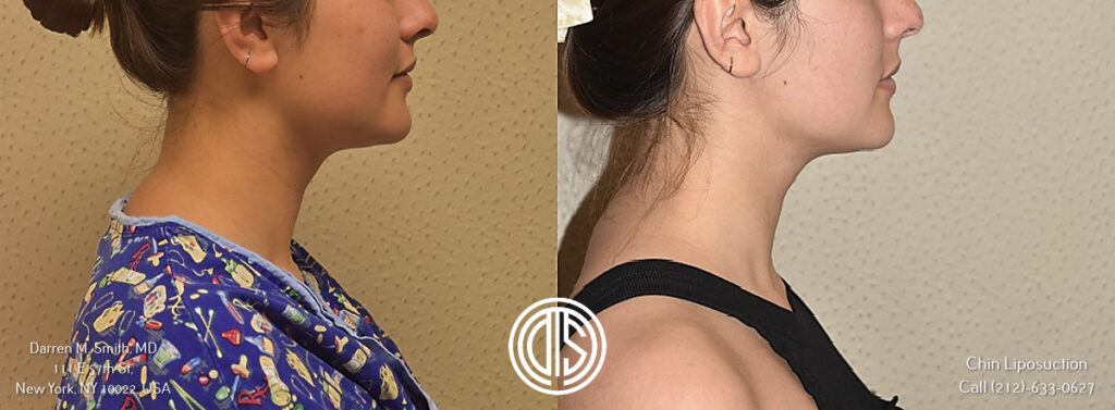 before and after portrait of a woman who underwent chin liposuction procedure