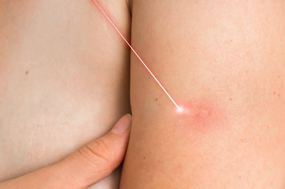 A woman's arm adorned with laser treatment to reduce visible scars from brachioplasty surgery.
