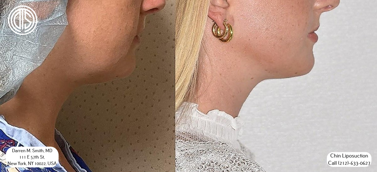 A woman's chin before and after a chin lipo procedure.