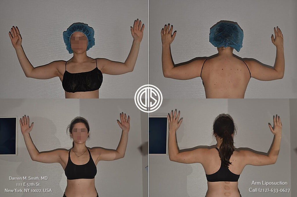 Four pictures of a woman's arm before and after surgery showcasing the transformative effects of brachioplasty.