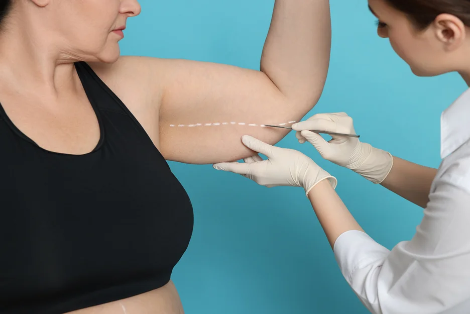 A woman is getting a brachioplasty procedure.
