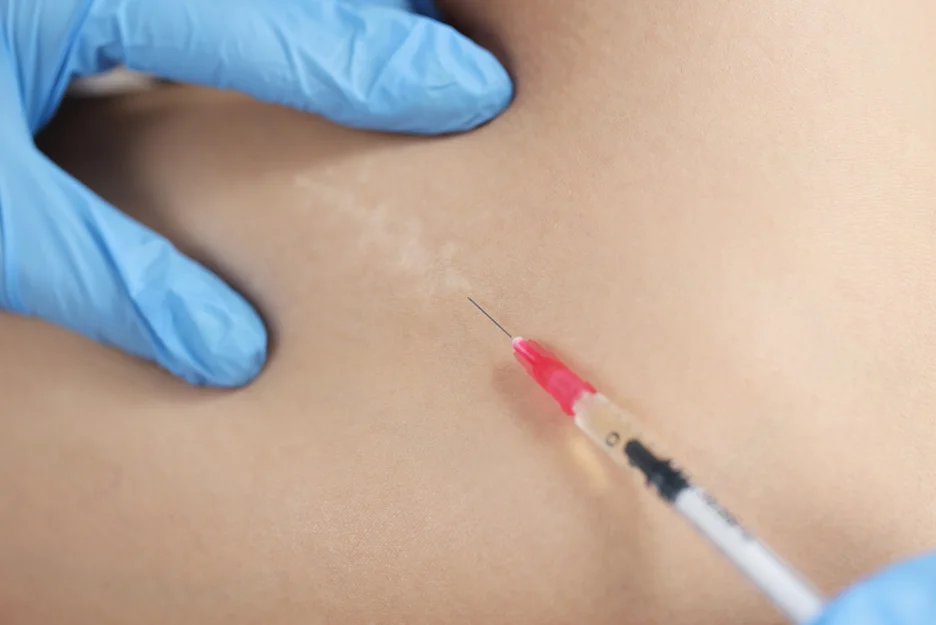A woman's gets corticosteroids injection on scars after brachioplasty.