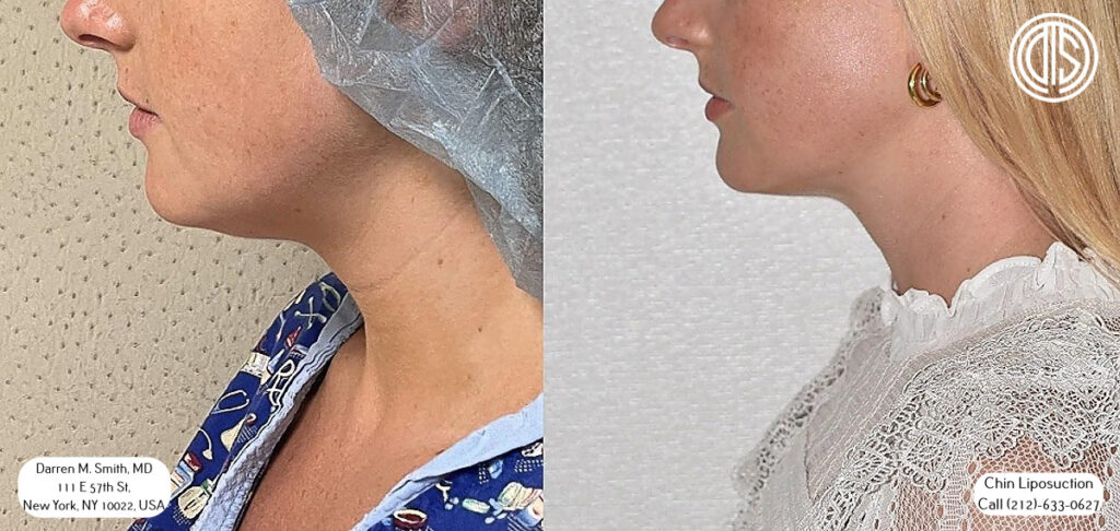 A side view of a woman's face featuring a slim profile.