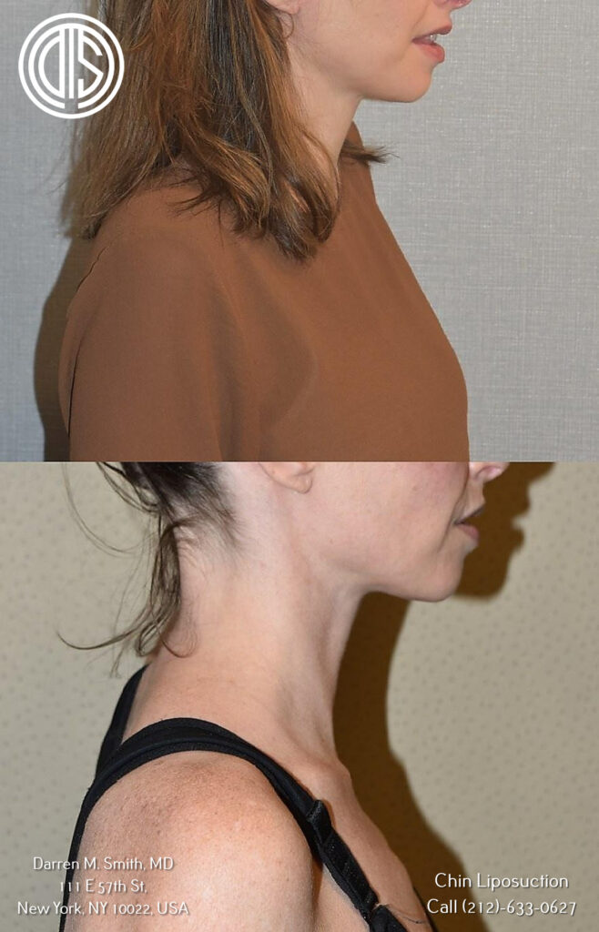 A woman's neck and chin before and after a J-Plasma.