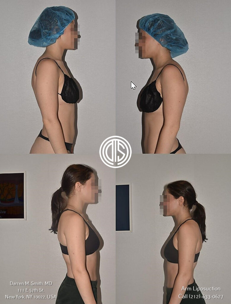 View before and after photos of a arm liposuction procedure for a significant relief in forearm pain.
