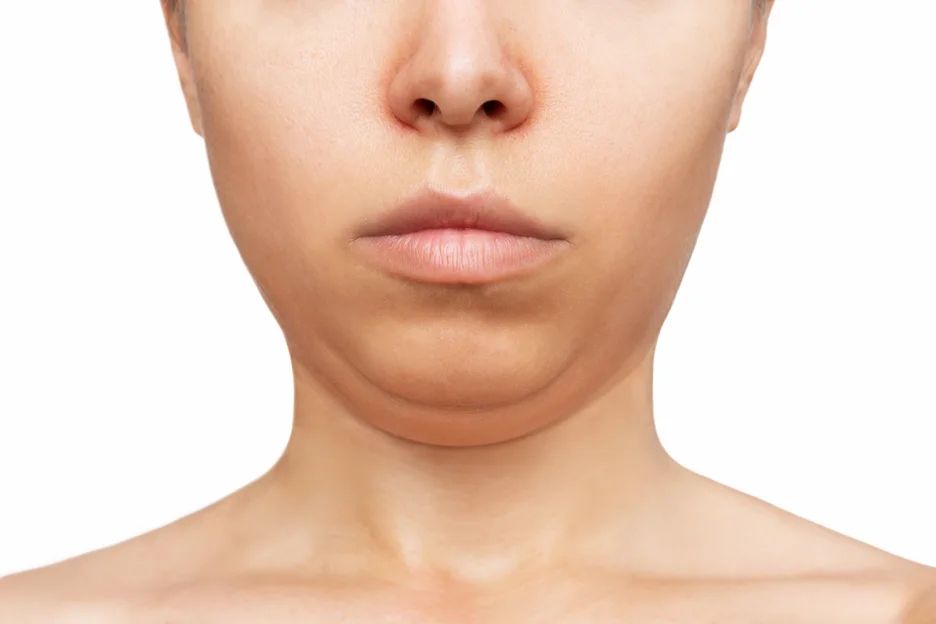 A woman's face with swollen neck and lumps.