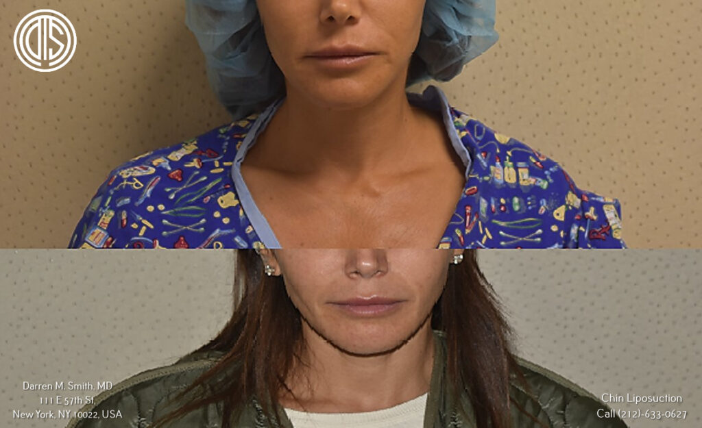 A woman's face before and after chin liposuction.
