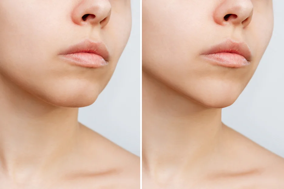 A woman's face before and after chin liposuction.