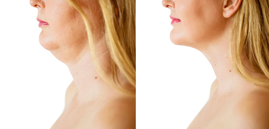 A woman's chin before and after liposuction.