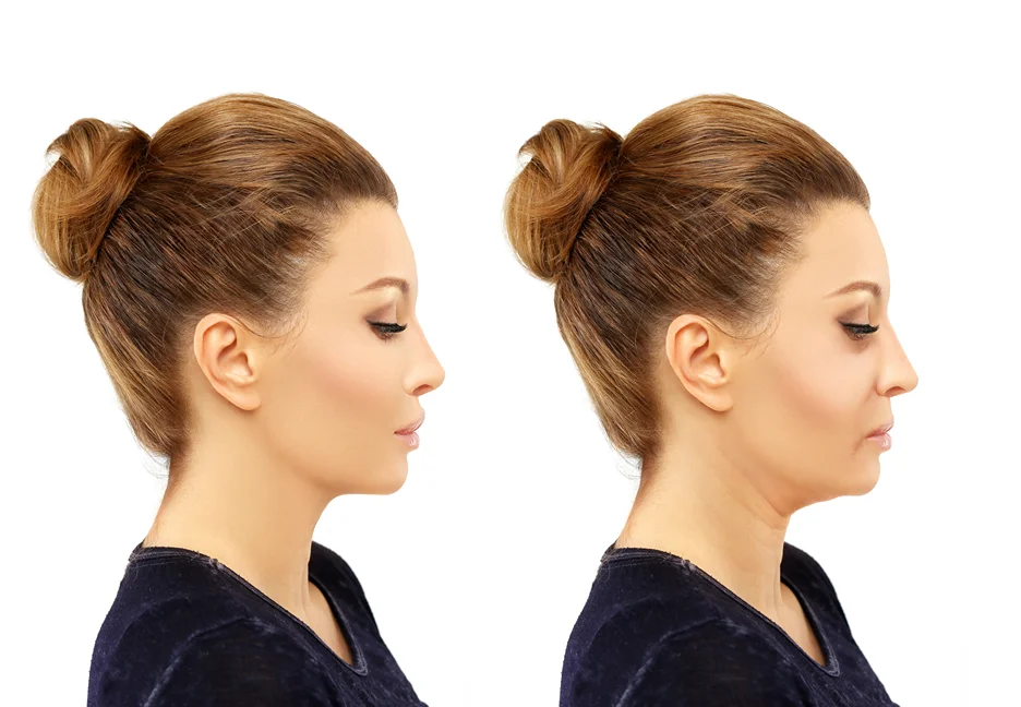 A woman's face before and after Victoria Paris Chin Lipo, showcasing an aesthetic transformation.