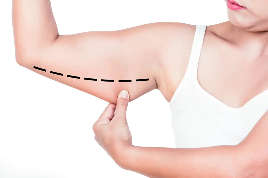 A woman pinching her fat arm
