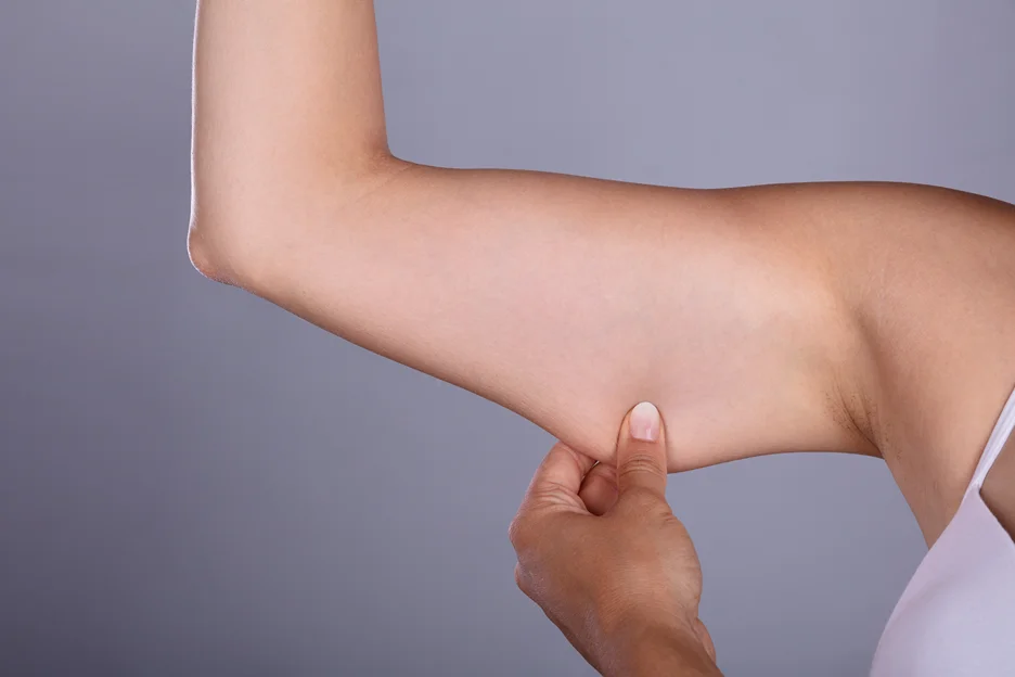A Woman pinching her arm before Liposuction