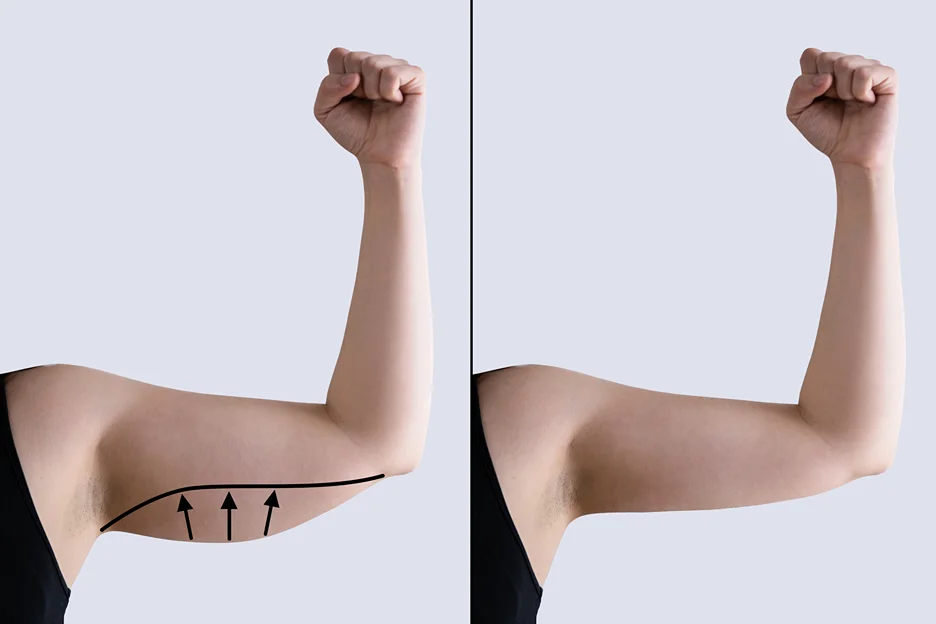 Before and After Result of Brachioplasty