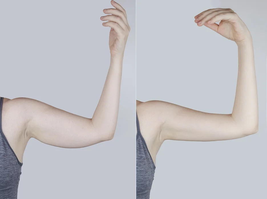 Before and After Result of Brachioplasty