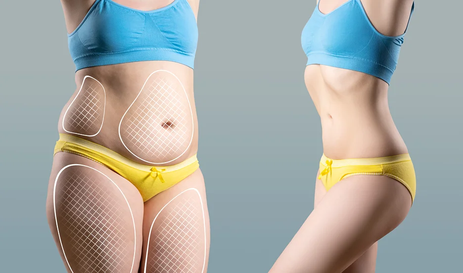Burning Sensation After Lipo 360