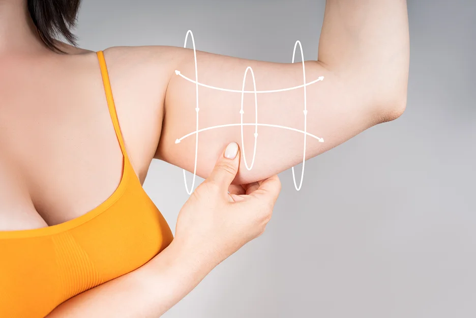 A Woman's Arm before Arm Liposuction