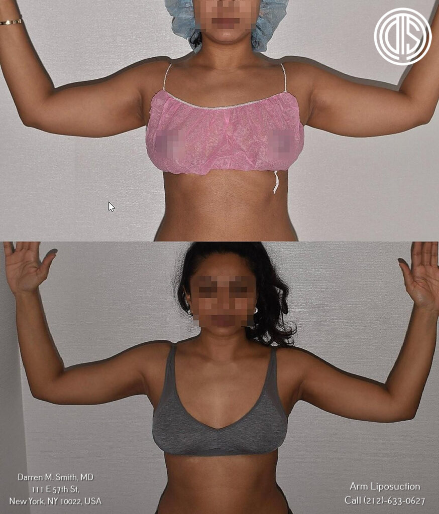 Arm Liposuction at Dr. Darren M. Smith