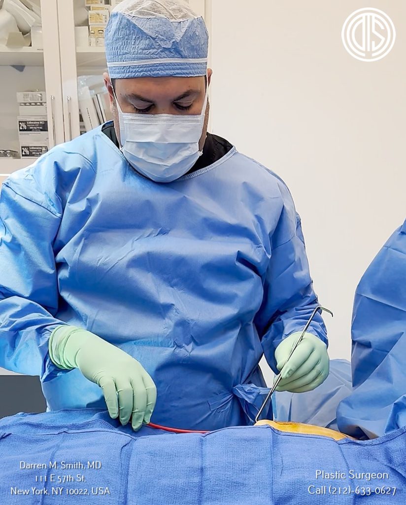 Lipo 360 Procedure at Dr, Darren M. Smith, MD