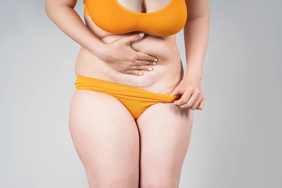 A Woman's Body Preparing For Mommy Makeover