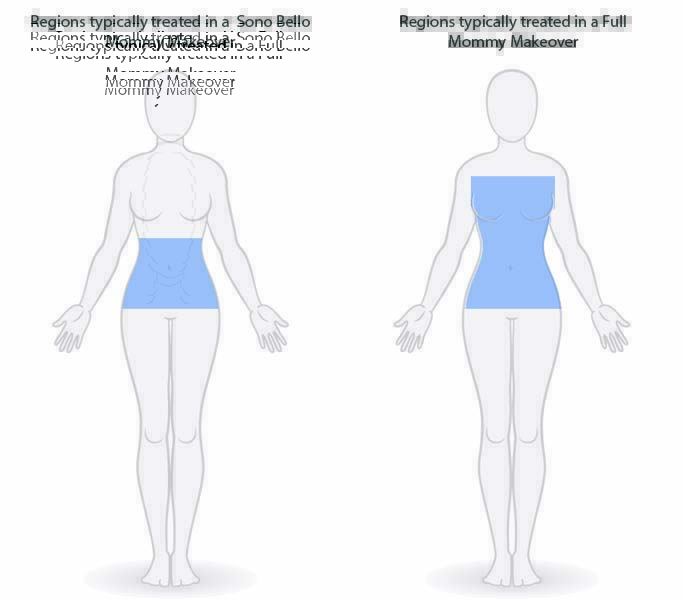 Illustration comparing the focus of Sono Bello versus a Full Mommy Makeover. Sono Bello targets the abdomen, while the Mommy Makeover addresses both the abdomen and chest, highlighted in blue.