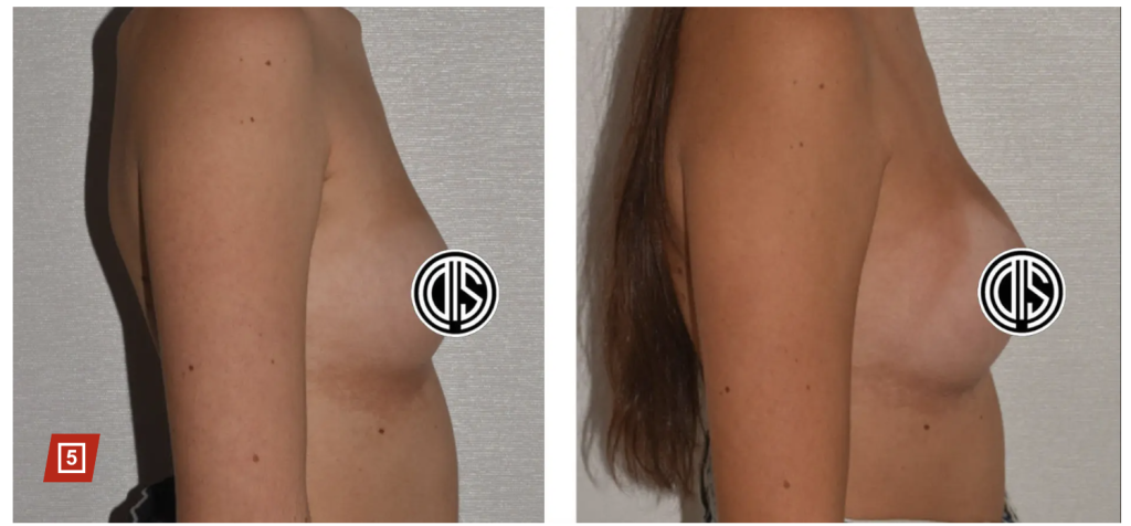 Side-by-side profile photos show a woman's chest before and after breast augmentation, highlighting changes in size and shape to achieve Yoga Boobs, a look inspired by the popular yoga trend. Identifying marks are covered for privacy.