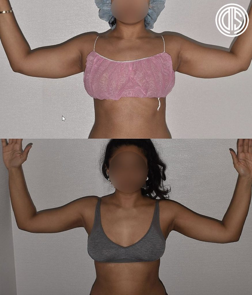 Two side-by-side photos show a woman with arms raised before and after Skinny Arm Liposuction, highlighting reduced upper arm size and toned arms. Her face is blurred for privacy.